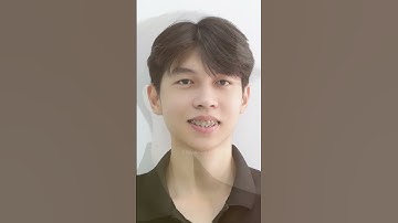 Khuôn mặt trước và sau khi niềng răng hô | #shorts