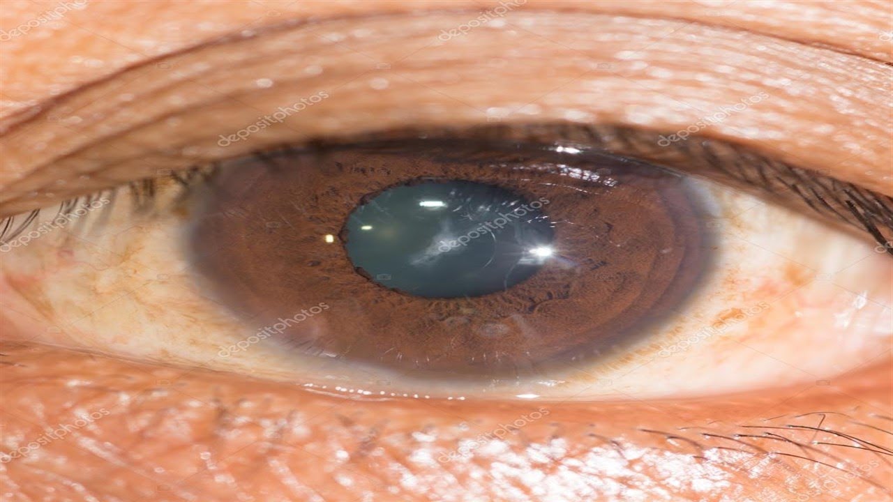 Qu son las cataratas en los ojos