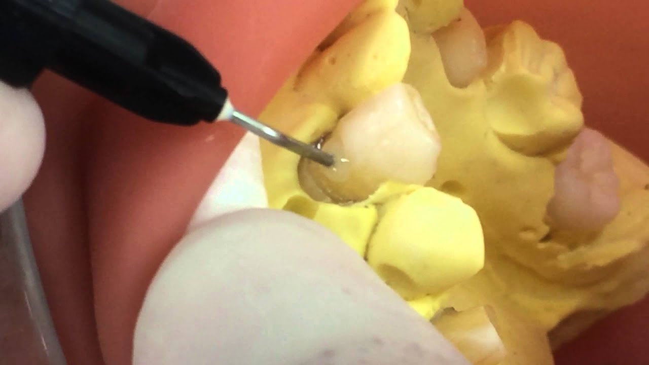 歯頸部CR治療(8/13)CR充填第一段階