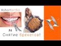 Идеальная улыбка к свадьбе за 6 месяцев. Снятие брекетов. (№4)