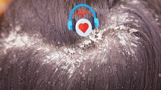 Extreme Scalp Transformation | Thick Dandruff Removal ASMR D00371