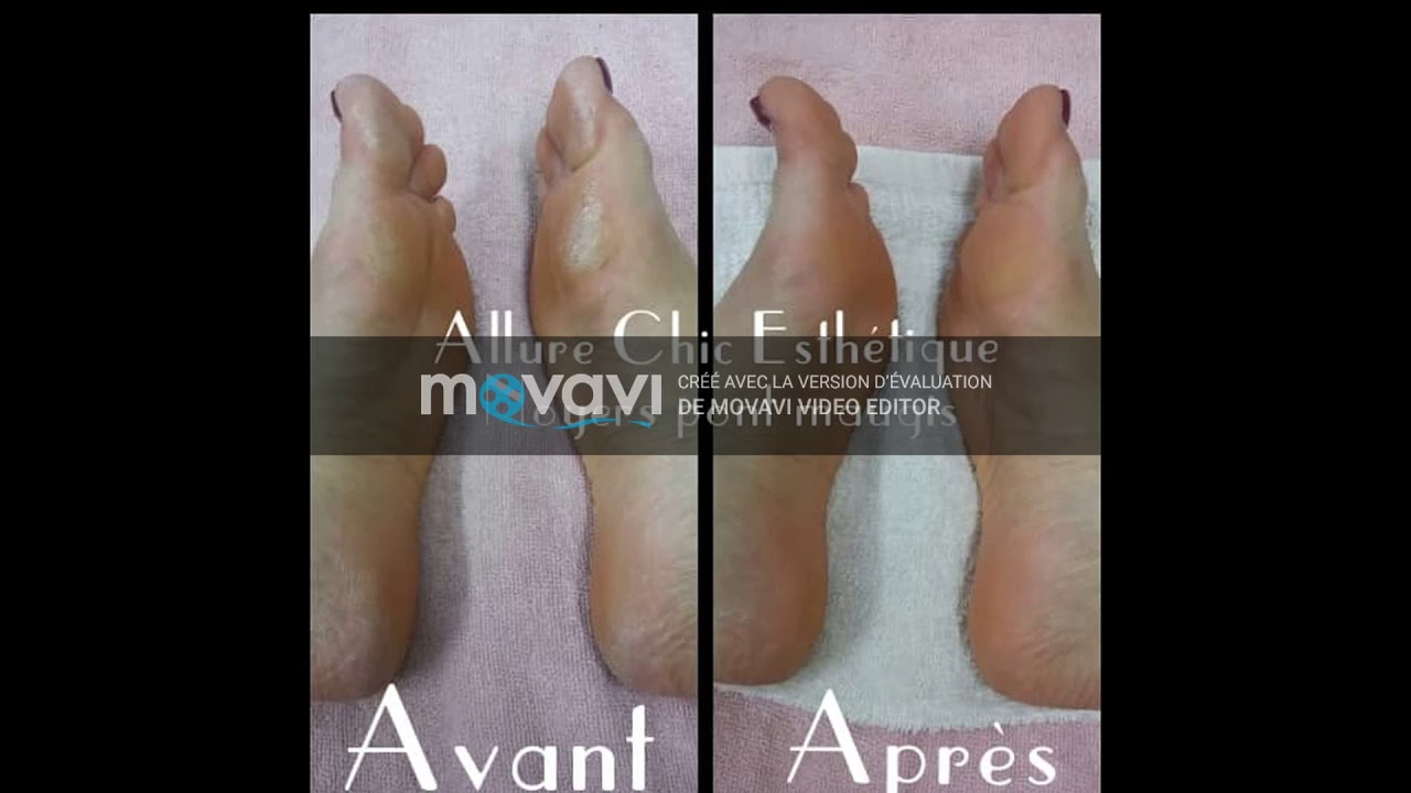 Traitement anti callosités des pieds, callus pelling, étape par étape