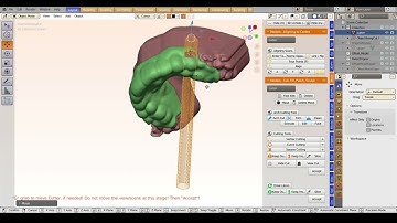 Gingivectomy - guide modelling