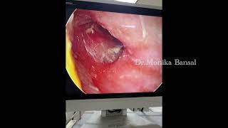 Sharp Foreign body Ear ( Removed under sedation) ,Shankari ENT Clinic,surat (8780193931)