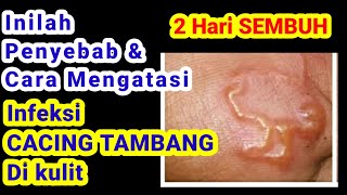 Cara Cepat Mengatasi / Menyembuhkan Infeksi Cacing Tambang Di Kulit (Cutaneus Larva Migran)