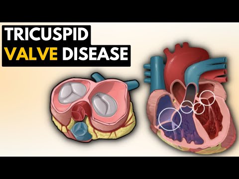 Video: Tricuspidová Regurgitácia (tricuspidálna Ventilová Nedostatočnosť)