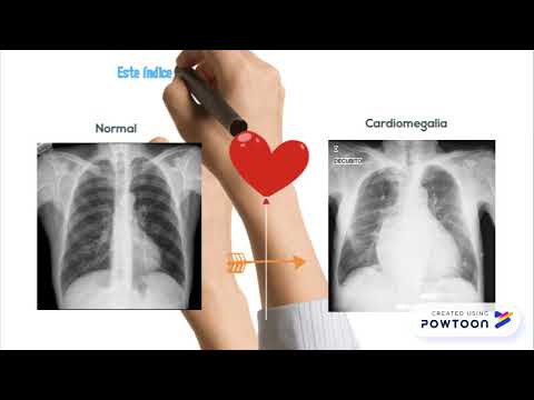 Como medir el indice cardiotoracico