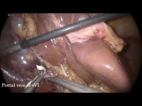 STANDARDIZED PURE LAPAROSCOPIC RIGHT HEPATECTOMY