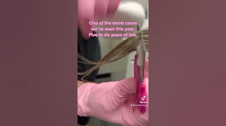 Millions of lice. Such relief at the end. #fyp #lice