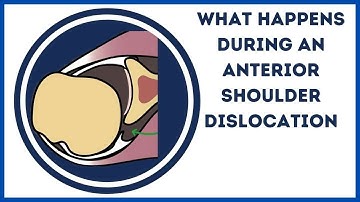 What happens during an Anterior Shoulder Dislocation?