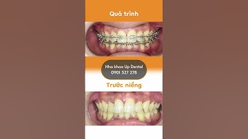 Hành trình LỘT XÁC nhờ niềng răng của Sơn Phước