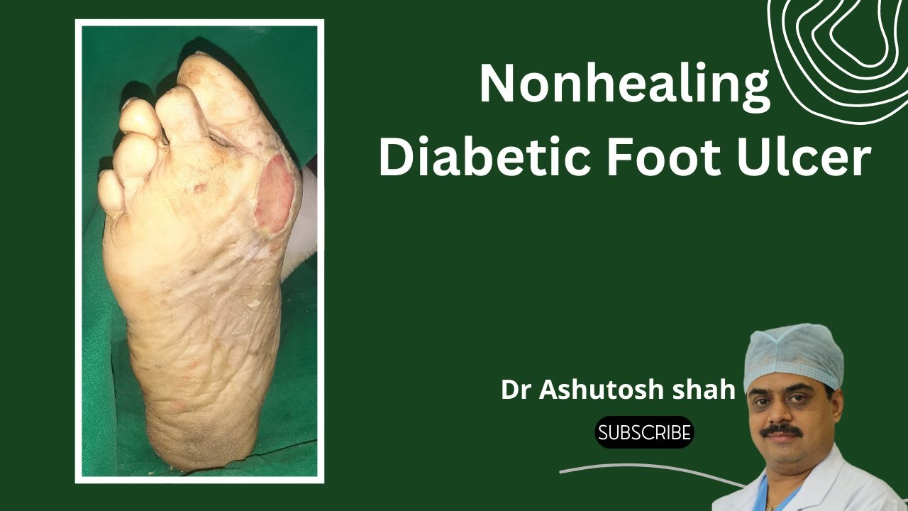 Nonhealing Diabetic Foot Ulcer Treatment, Diabetic Wounds on Toe, Surat