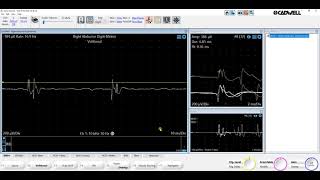 EMG+ Adding the Stability Window Cadwell EMG Sierra Summit v3 1