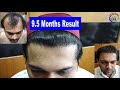 Full Journey of Hair Transplant - Natural Hair Line - Best Hair Transplant Result - 9.5 Month Result