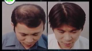 Biohairs Ez Shop Indonesia - Solusi Kebotakan pada Rambut