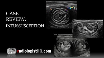 Ultrasound of Intussusception