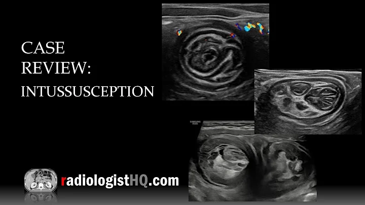 Ultrasound of Intussusception