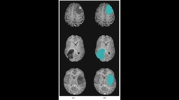 Brain Tumor Segmentation and Classification using Dense Layer Neural Network Matlab | +91-8283824812