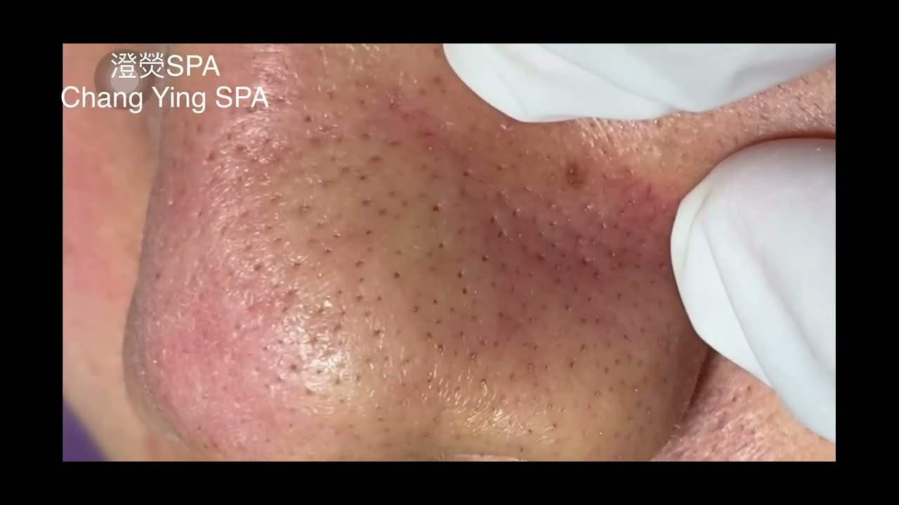 鼻子粉刺清除「中壢清粉刺」「中壢做臉」Nose comedone & blackhead cleaning