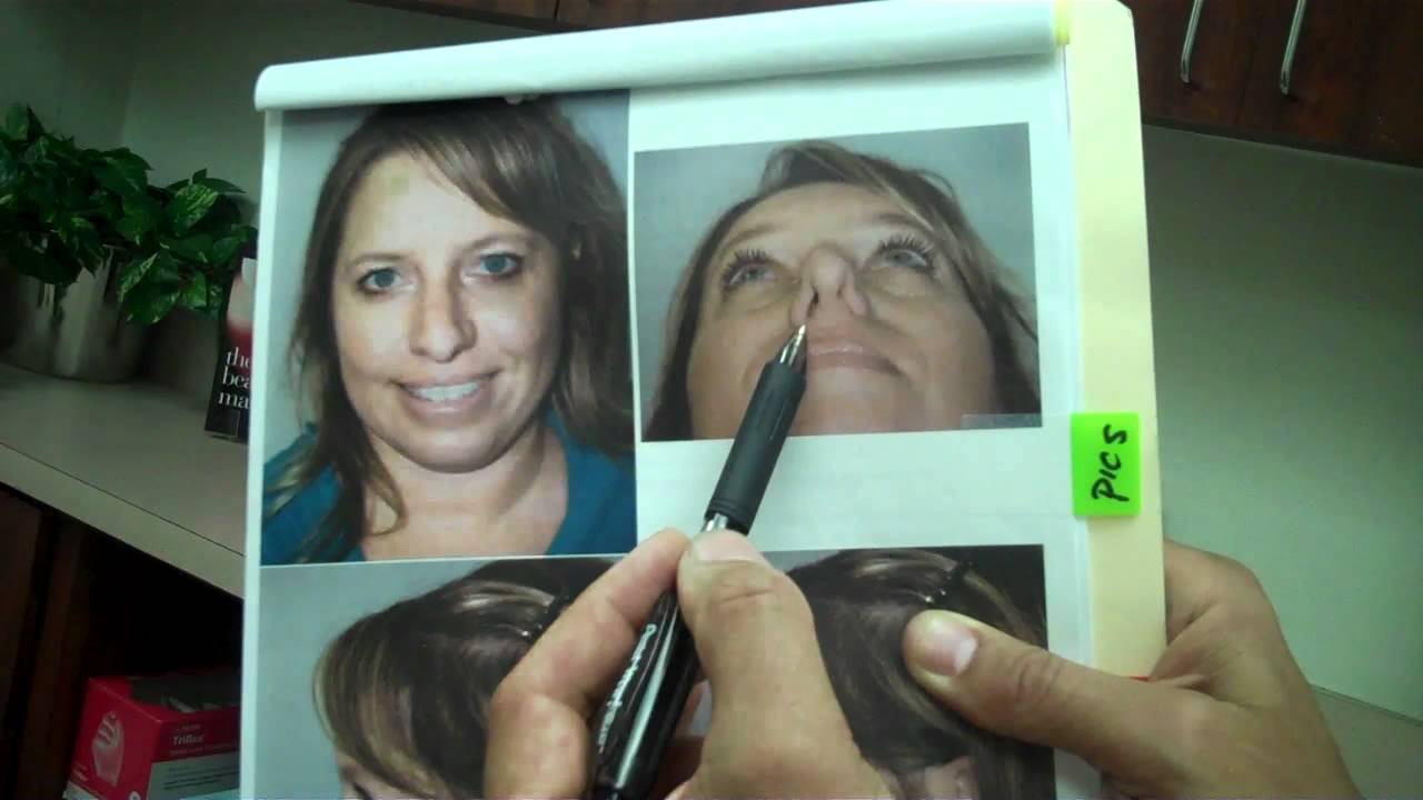 Facial Plastic Surgeon Dr. Jeffrey Epstein / Revision Rhinoplasty Procedure