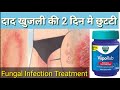 दाद का घरेलू इलाज |Fungal Infection Treatment at Home|#khujlikailaj|#daadkailaj|#fungal|By Nida Ali