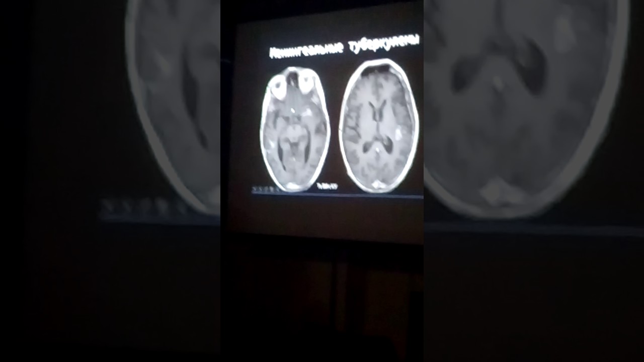 МРТ ГМ ВИЧ Туберкулез