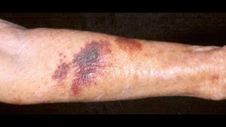 ACTINIC (SENILE) PURPURA Causes, Treatment: What is Senile (Solar) Purpura?