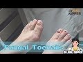 She has Fungus on Toenails.  Dr Nail Nipper Fungal Toenails Treatment