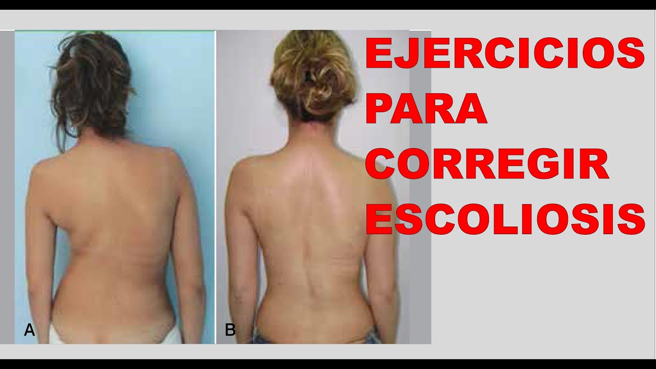 c-mo-corregir-escoliosis-youtube