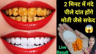 सिर्फ 10 रूपये में गंदे पीले दांतों को मोती की तरह चमका देगा / Teeth whitening remedy /dato ko white