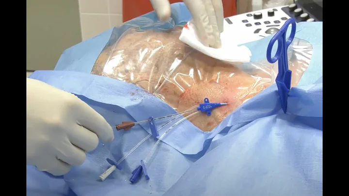 Central venous catheter insertion (Internal jugula...
