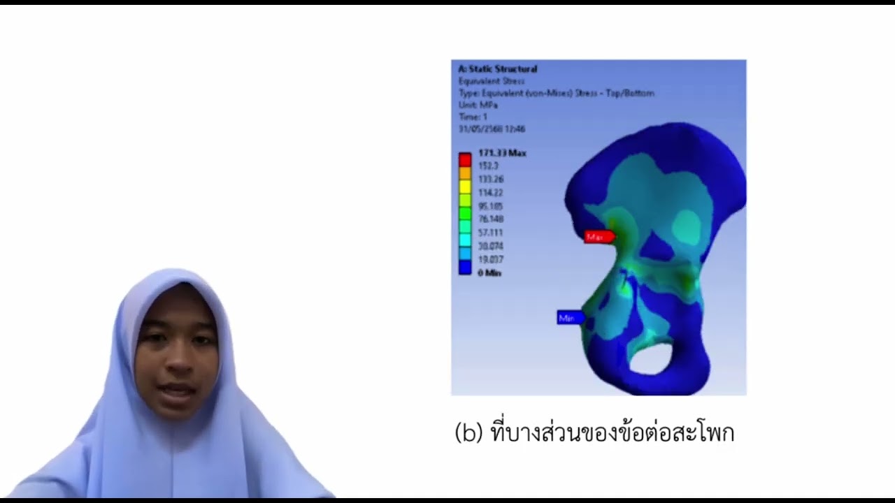 Dynamic Response of Bone Pelvis on the effect of various adjacent impulse loadings