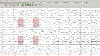 Celebrity Learn to Read EEGs Part - 4 Wealth