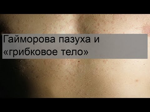 Гайморова пазуха и «грибковое тело»