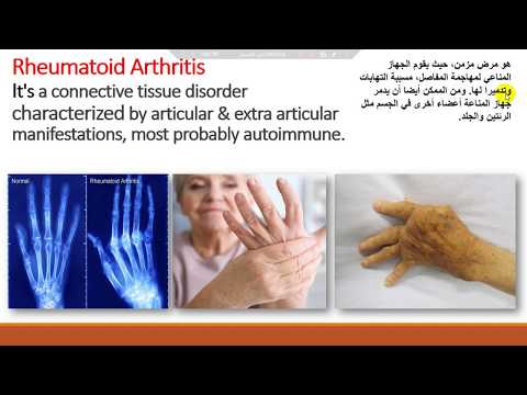 (محاضرة رقم ١) التهاب المفاصل الروماتويدي Rheumatoid arthritis