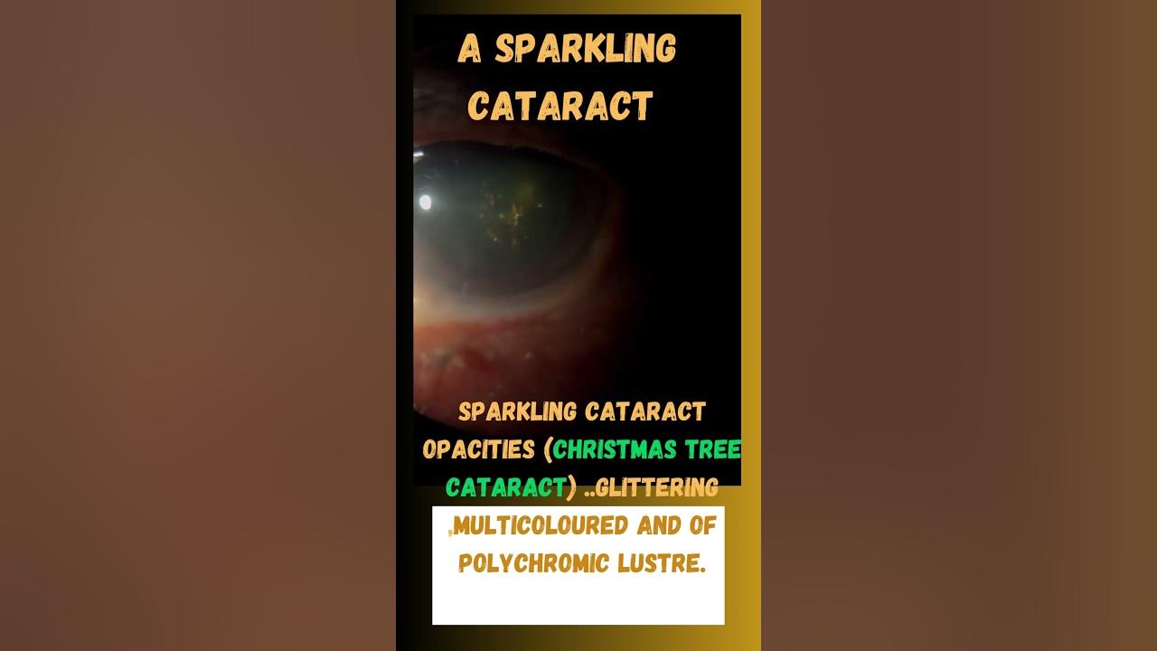 SPARKLING CATARACTChristmas Tree Cataract!eyedoctorneetpg