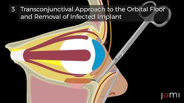 Step by Step : Neuronavigation and Endoscopy