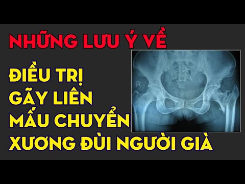 Gãy liên mấu chuyển xương đùi có phải mổ không?