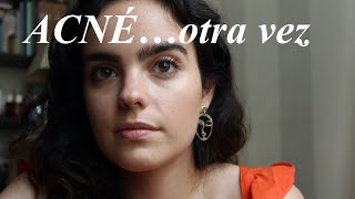 mi rutina contra el acné después de la isotretinoina y la píldora | YesStyle + The Ordinary by Nieves Ugarte 2,970 views 2 years ago 17 minutes