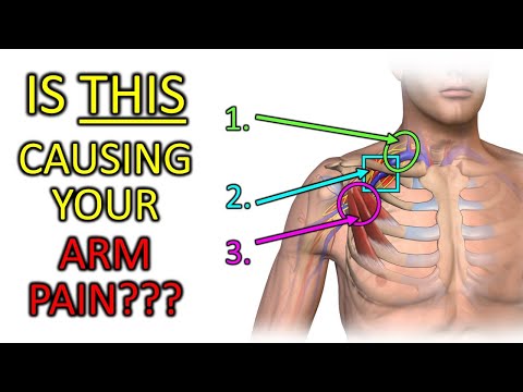 How to Fix Arm Muscle Pain in 30 SECONDS 