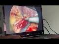 IKEDA FHD Laparoscopic Surgery - 9124 Compact Imaging Solution