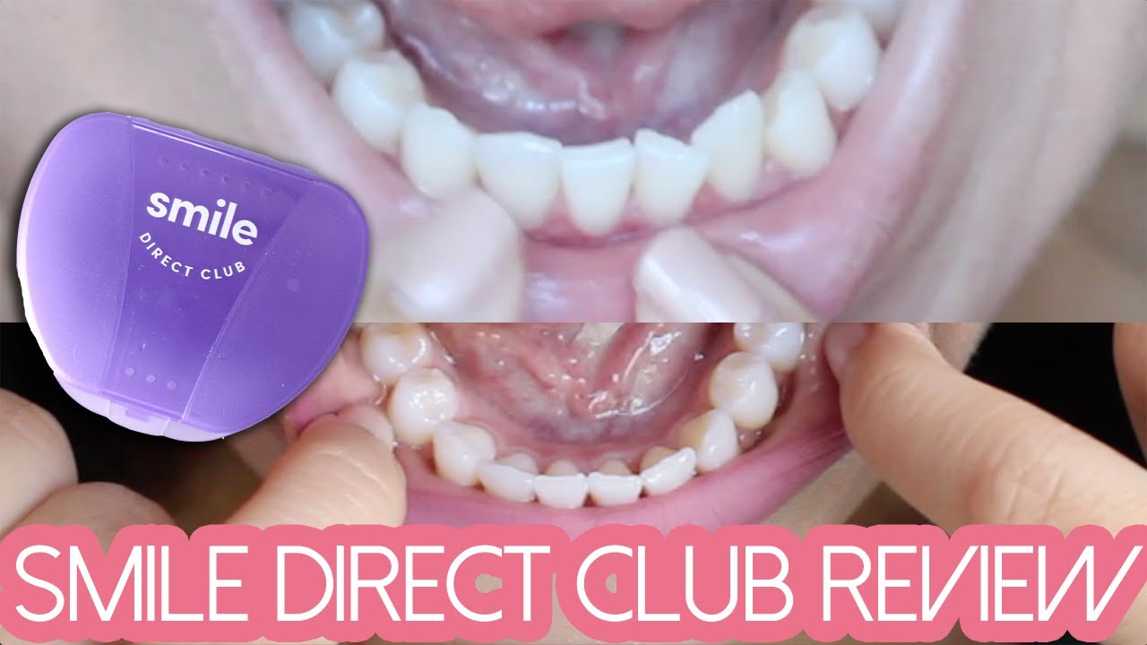 SMILE DIRECT CLUB REVIEW: Final Thoughts - YouTube