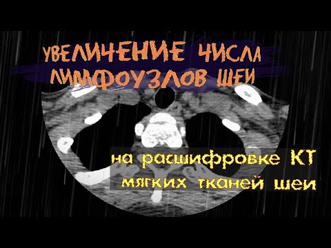 Признаки ВОСПАЛИТЕЛЬНОГО процесса (ЛИМФАДЕНОПАТИЯ шейных лимфоузлов) на РАСШИФРОВКЕ КТ (2 мнение)