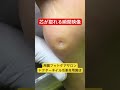 【魚の目】取れる瞬間映像【用賀フットケアサロン】#フットケア #魚の目