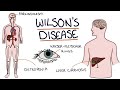 Understanding wilsons disease