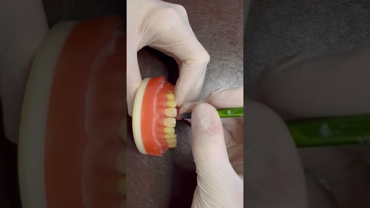 Fechamento de diastema com resina composta 😎