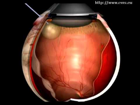 Video: Verkkokalvon Laserkoagulaatio