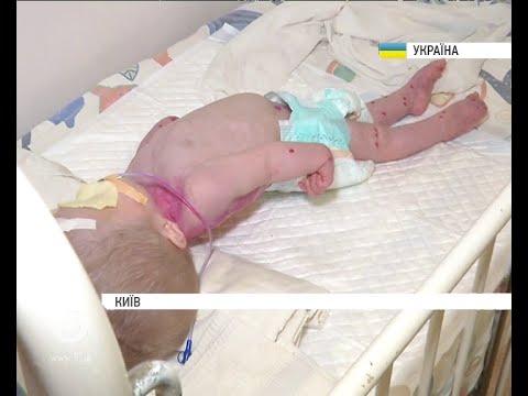 У лікарні Києва виявили занедбану хвору 1-річну сироту