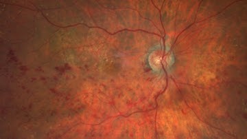 Hemi CRVO - Nidhi Sama, MD - 2025 12 12  - USF Ophthalmology