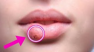 Cold Sore Remedies - Fever Blisters + Cold Sore Home Remedies - How to Get Rid of Cold Sore Fast